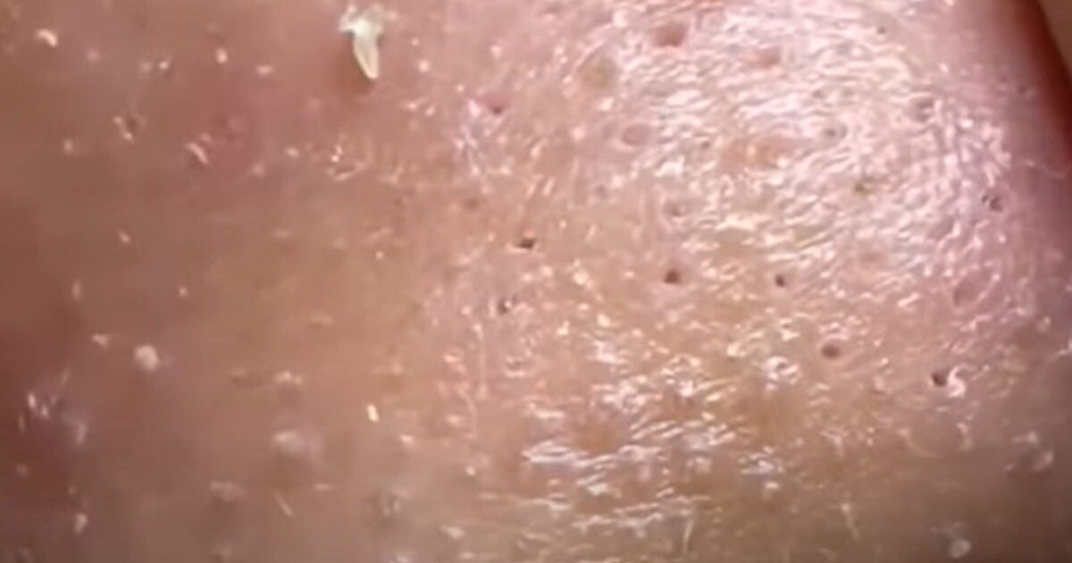 Trik Aman Melawan Jerawat di Hidung