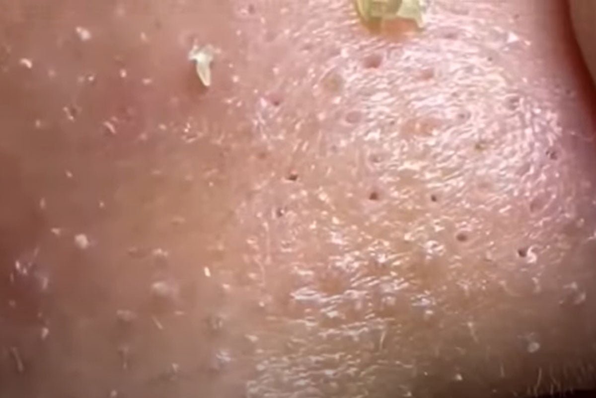 Trik Aman Melawan Jerawat di Hidung
